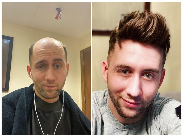 Toupee vs bald hotsell